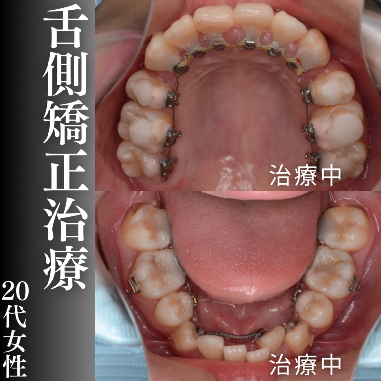 舌側矯正治療